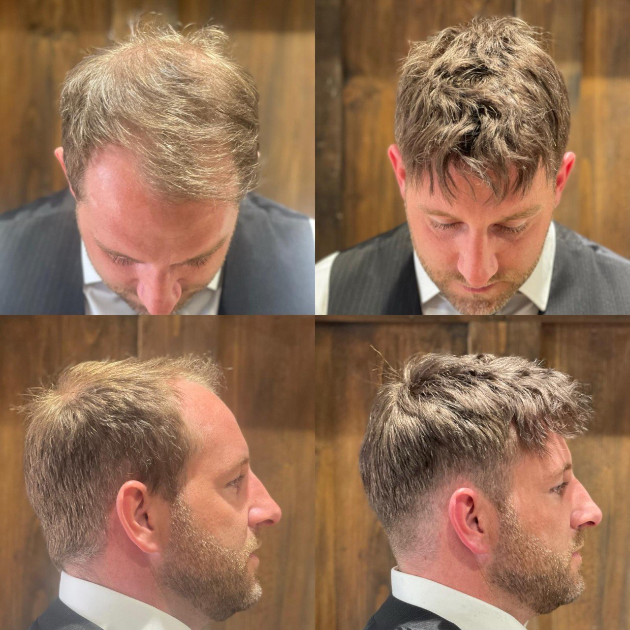How To Disguise Hair Loss
