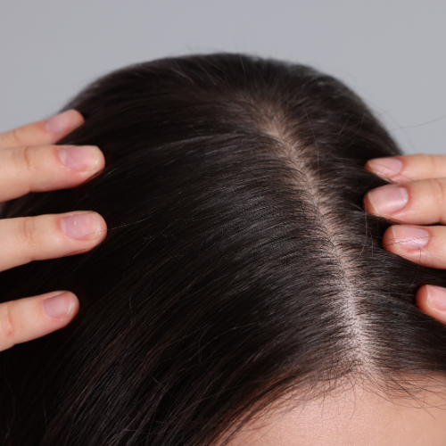 Scalp Health in Taunton